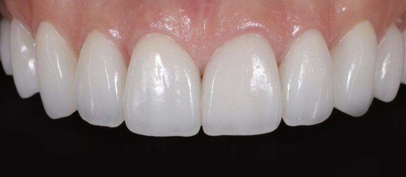 After - Veneers at Vineyard Dental & Orthodontics