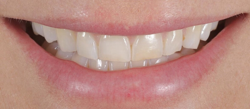 Before - Veneers at Vineyard Dental & Orthodontics