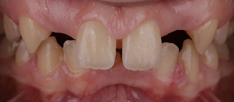 Before - Veneers at Vineyard Dental & Orthodontics