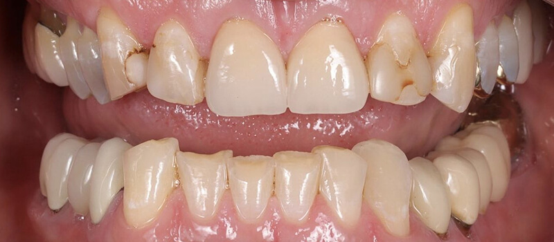 Before - Veneers at Vineyard Dental & Orthodontics