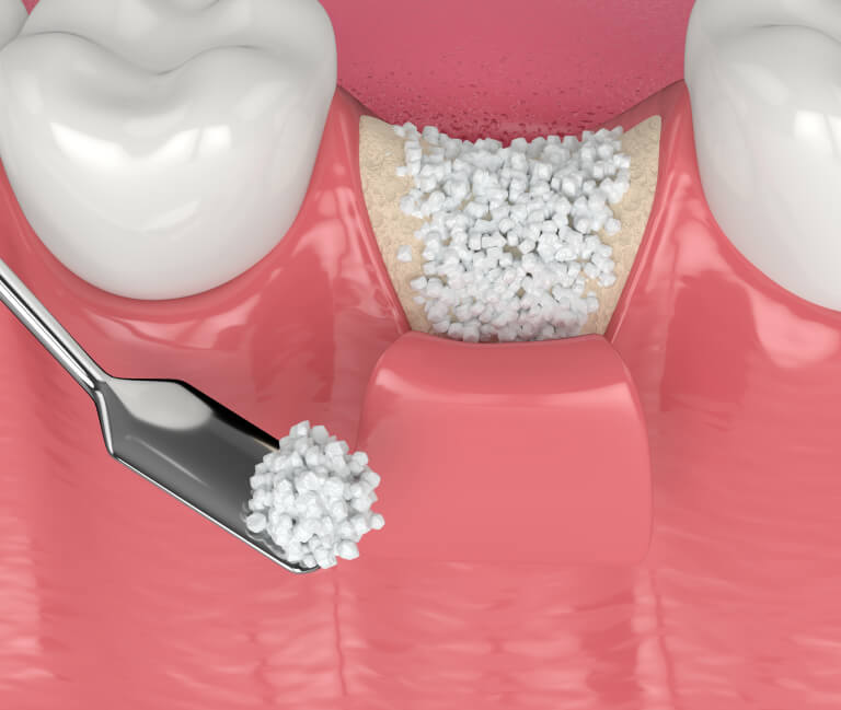 Is Bone Grafting Right
