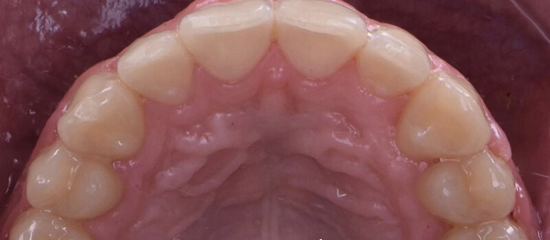 After - Braces at Vineyard Dental & Orthodontics