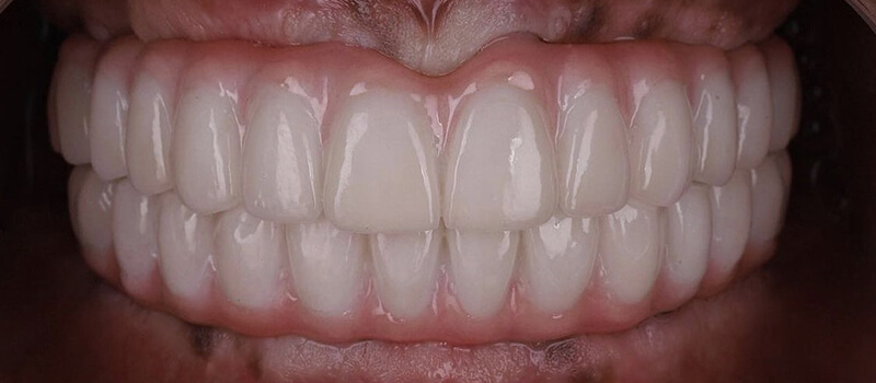 After - All-on-4 at Vineyard Dental & Orthodontics