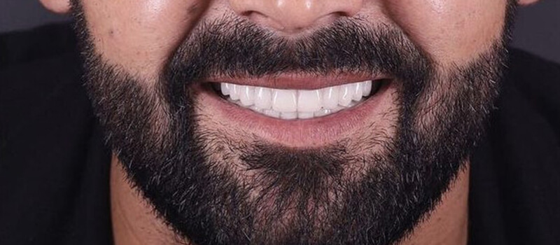 After - All-on-4 at Vineyard Dental & Orthodontics