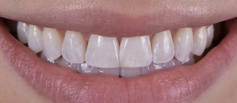 After - Invisalign at Vineyard Dental & Orthodontics