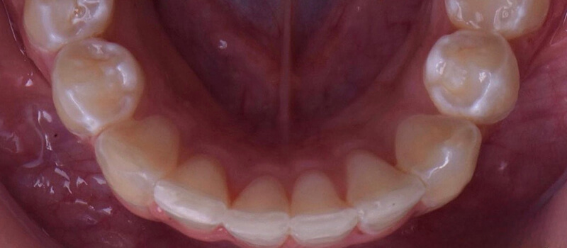 After - Invisalign at Vineyard Dental & Orthodontics