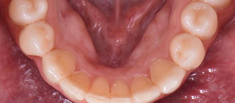 After - Invisalign at Vineyard Dental & Orthodontics