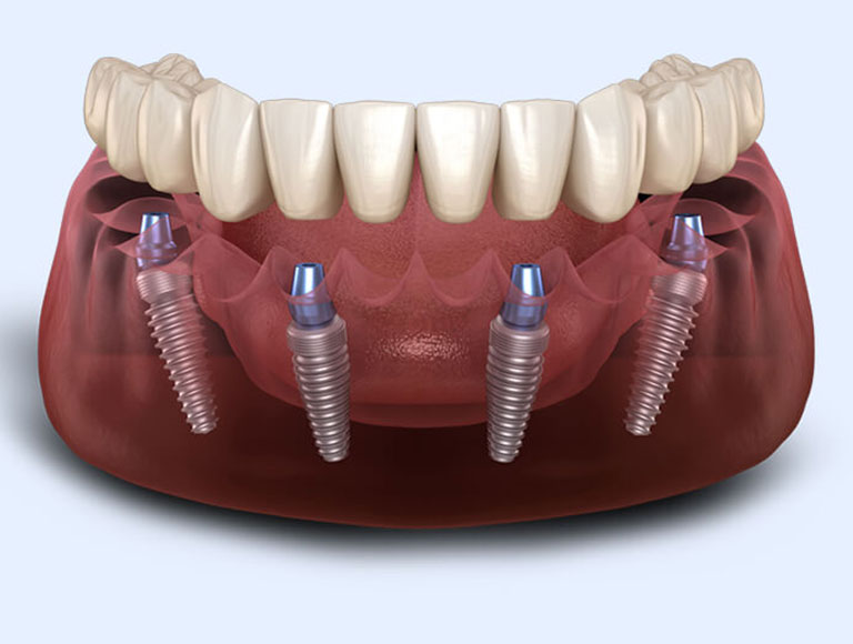 Transform Your Smile with the All-On-4® Technique