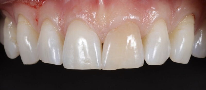 Before - Veneers at Vineyard Dental & Orthodontics