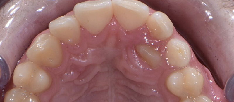 Before - Braces at Vineyard Dental & Orthodontics