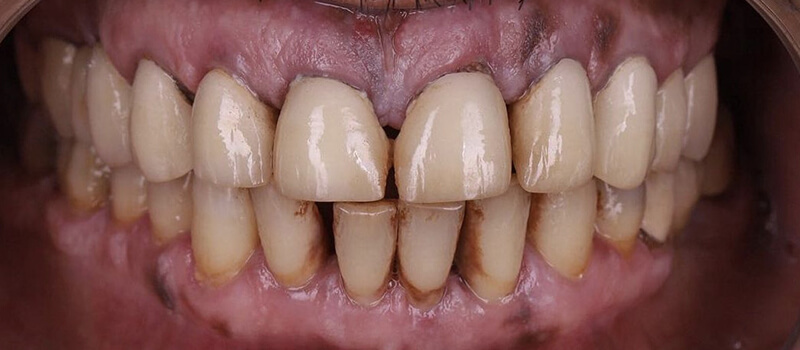 Before - All-on-4 at Vineyard Dental & Orthodontics