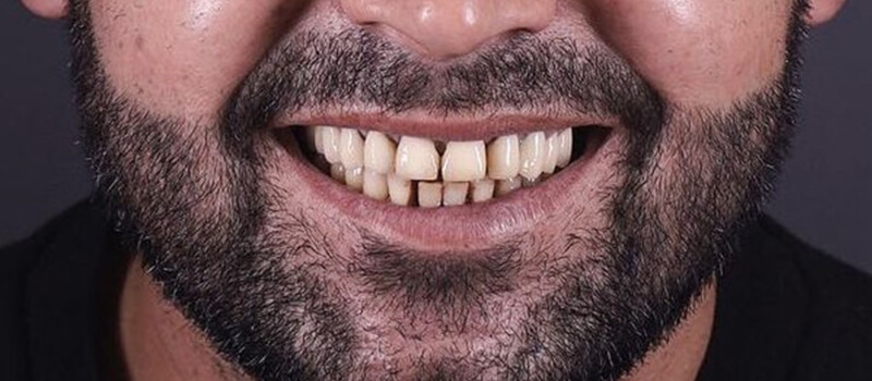 Before - All-on-4 at Vineyard Dental & Orthodontics