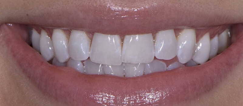 Before - Invisalign at Vineyard Dental & Orthodontics