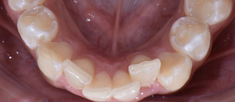 Before - Invisalign at Vineyard Dental & Orthodontics