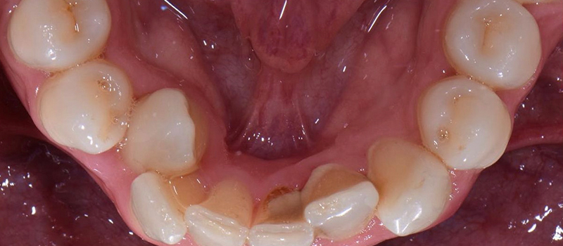 Before - Invisalign at Vineyard Dental & Orthodontics