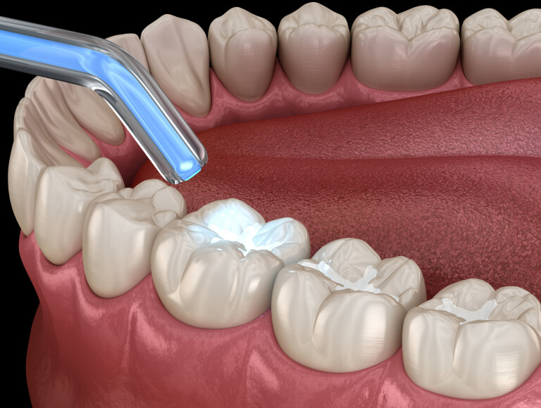 Is It Time for a Dental Filling?