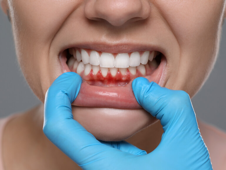 Signs of Gum Disease