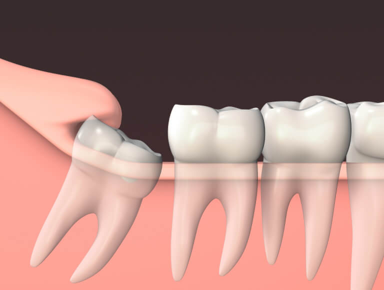 Signs of Wisdom Teeth