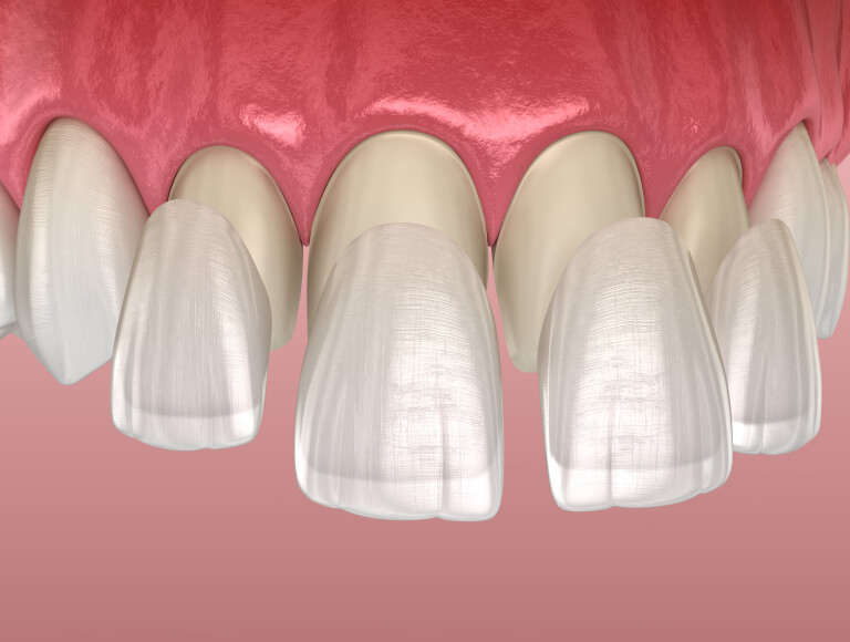 Are Dental Veneers the Right Choice for You?