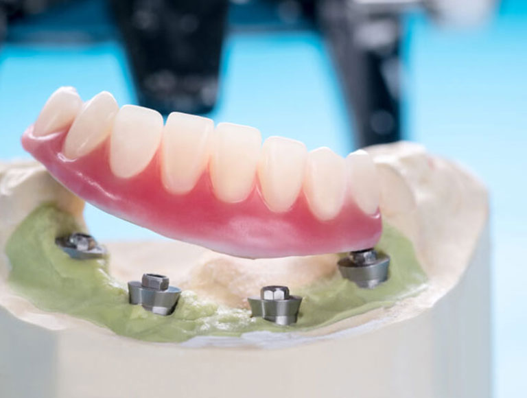 Implant-Supported Dentures for Stability and Comfort