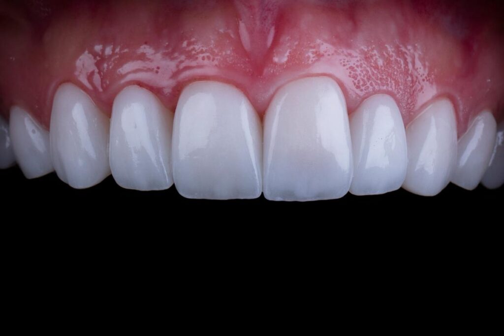 Dental Veneers: Transforming Smiles in Paso Robles