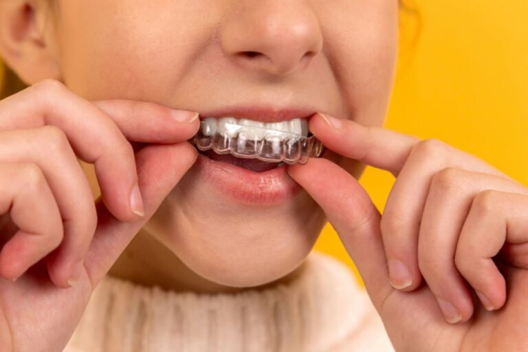 Clear Aligners: Straighten Your Smile Discreetly