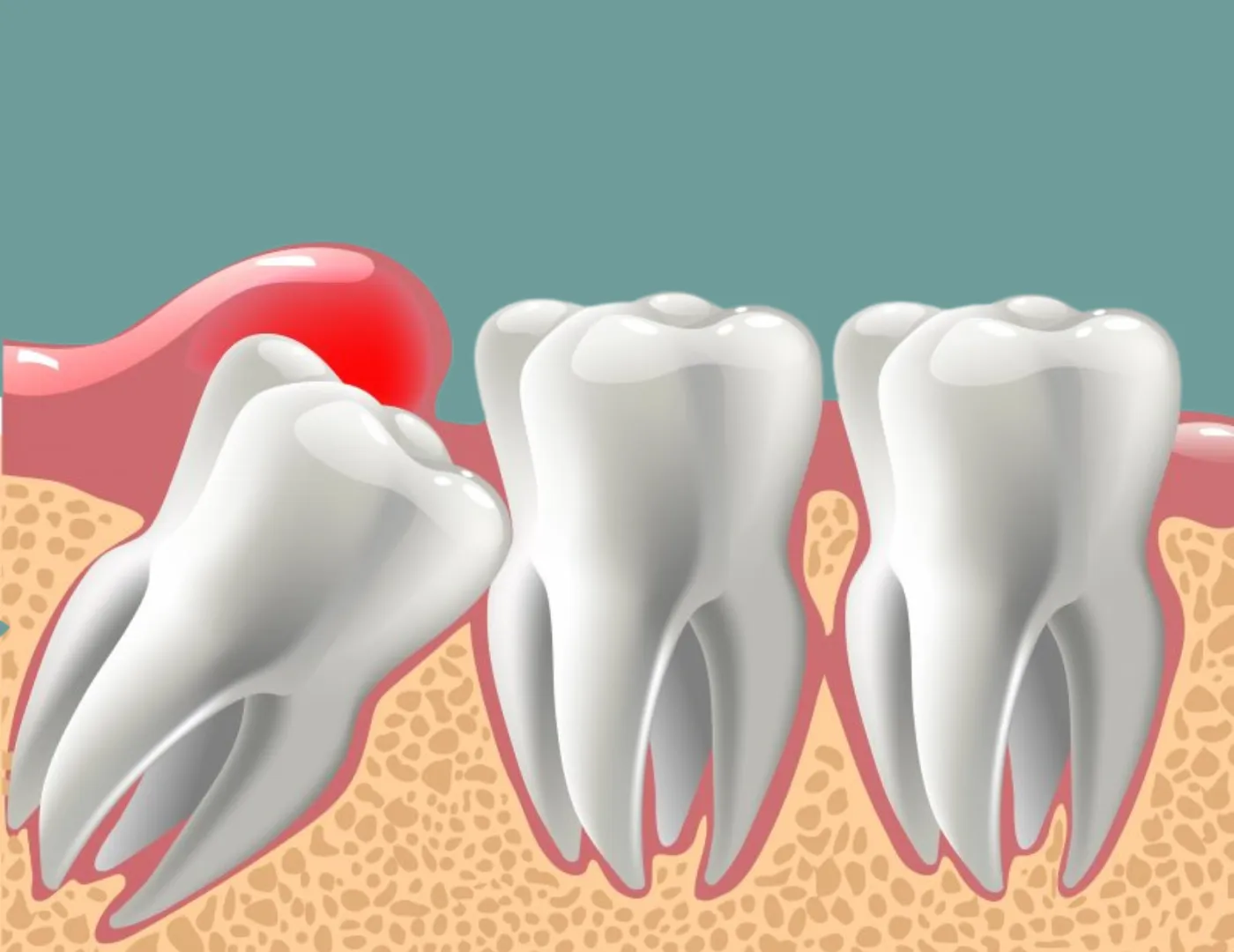 Wisdom Teeth Removal