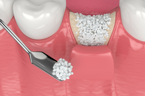 Bone Grafting