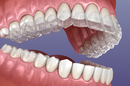 Clear Aligners