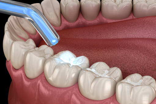 Dental Fillings