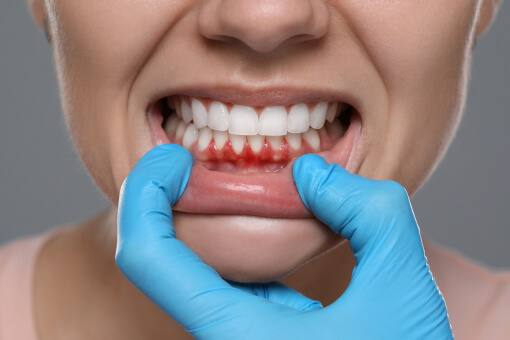 Gum Disease Treatment