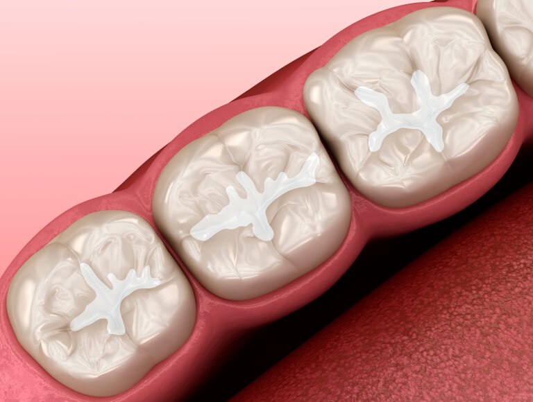 Benefit from Dental Sealants