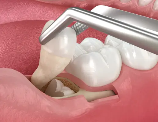 Wisdom Teeth