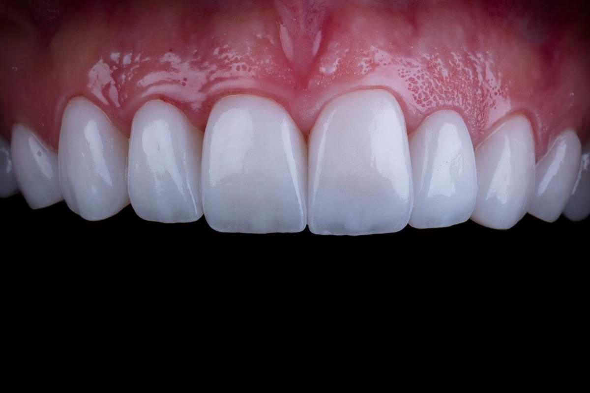 Dental Veneers